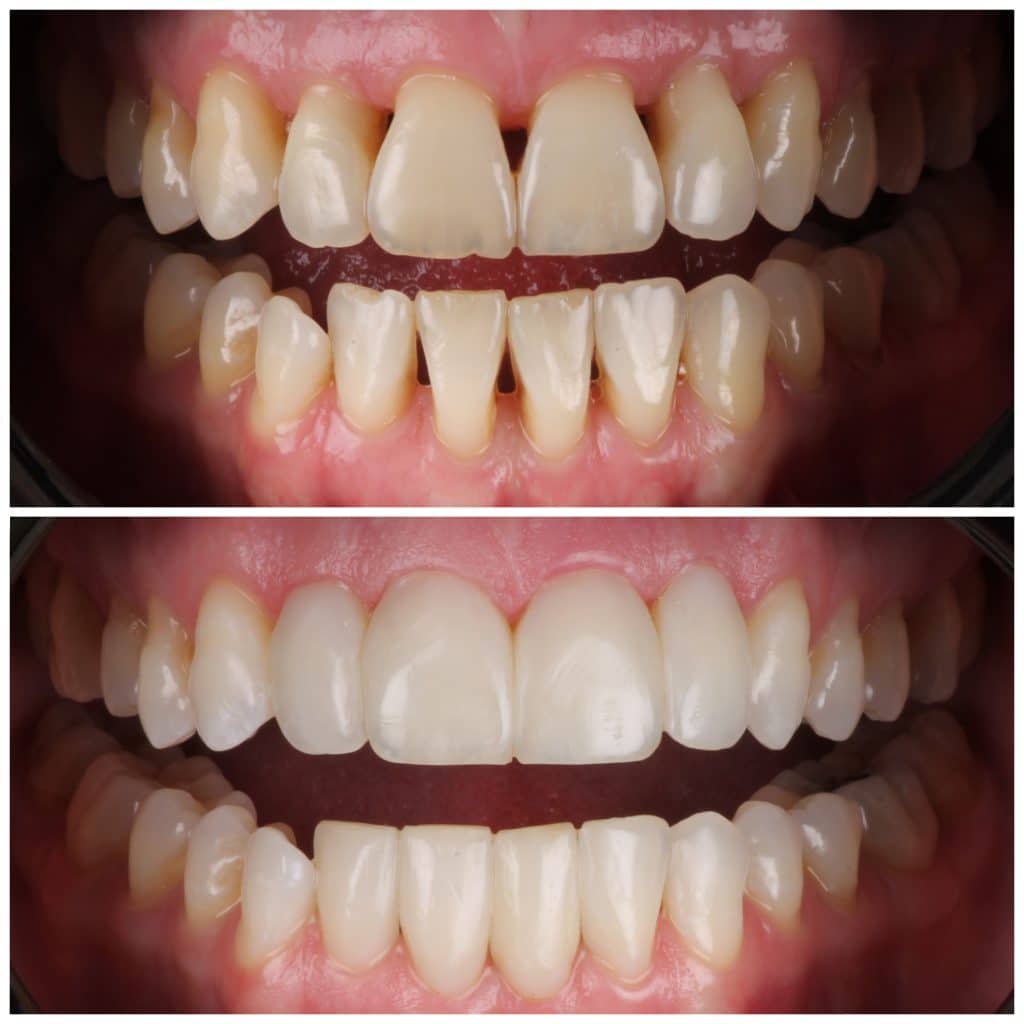 Black Triangles fixed with Bioclear Method
