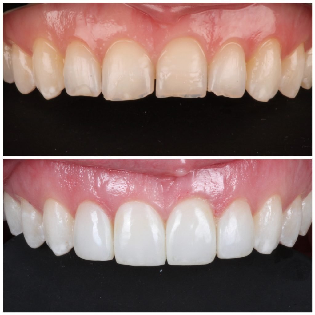 highlight Composite veneers