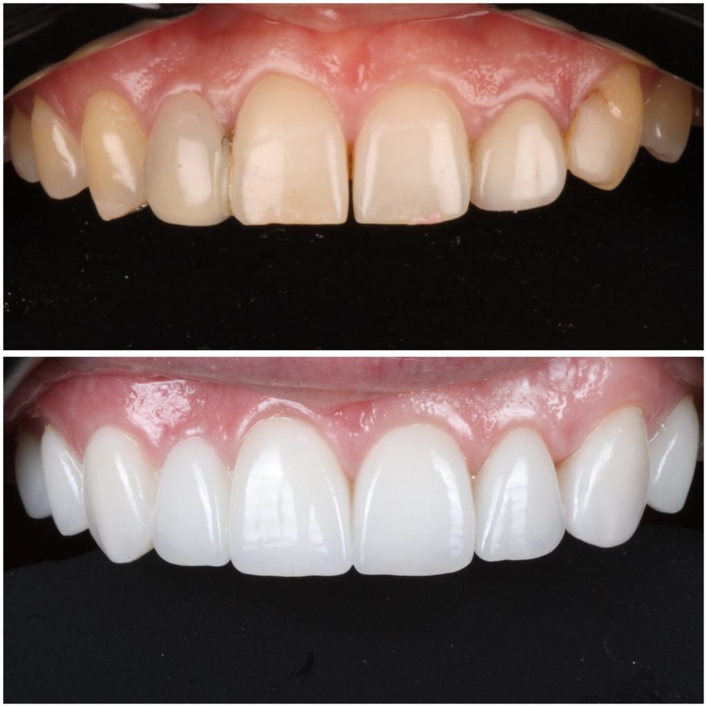 Porcelain Veneers and Bridges Smile makeover