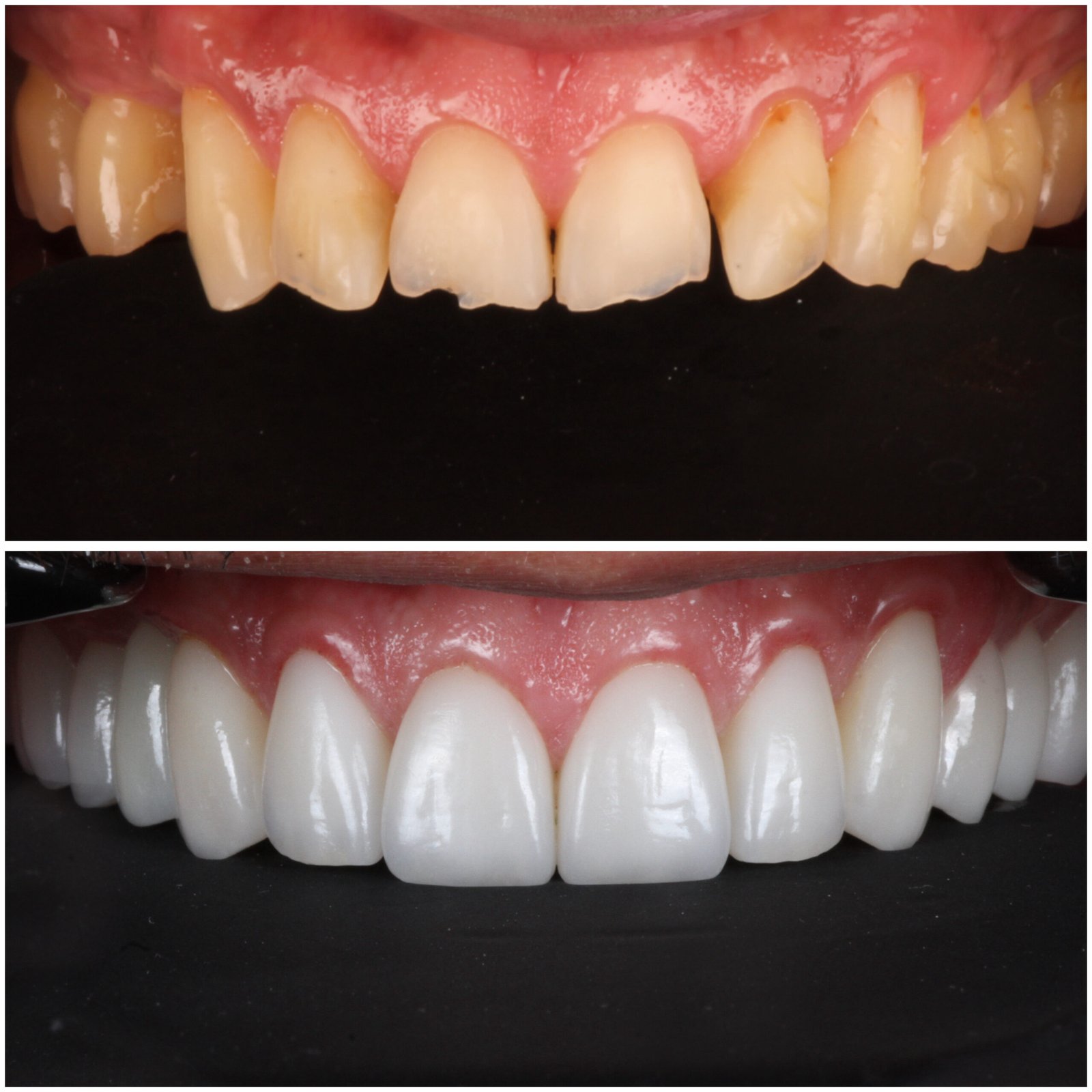 Broken Teeth fixed with Veneers