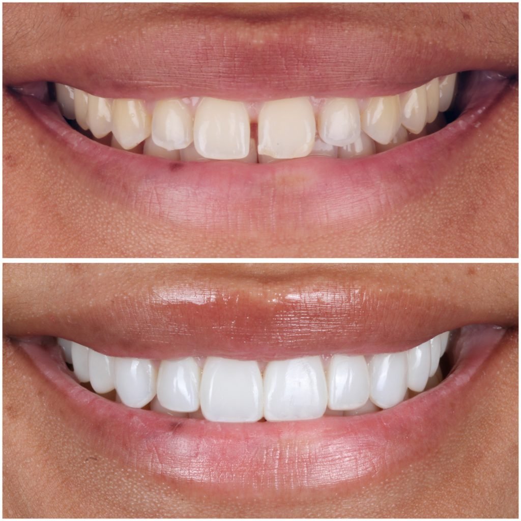 Highlight Composite Veneers