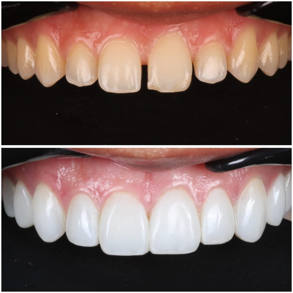 Highlight Veneers