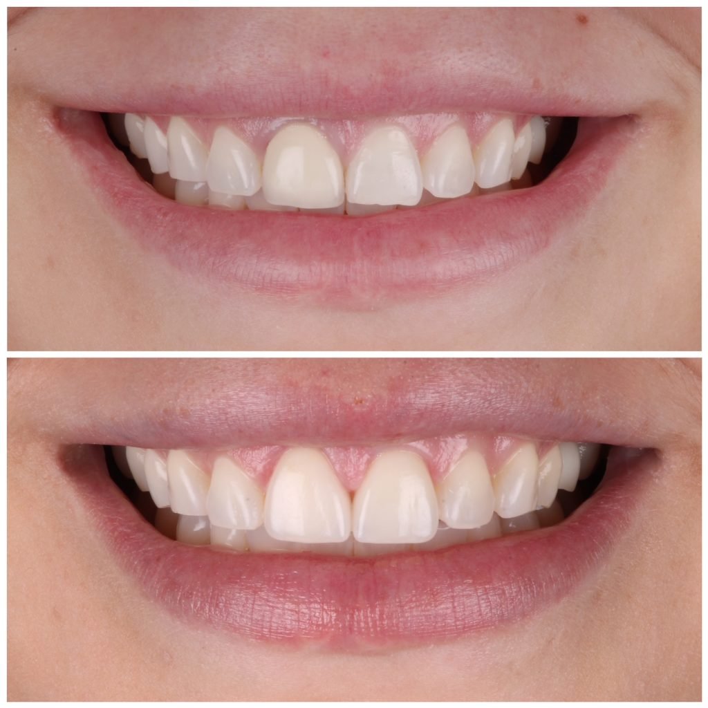 2 Porcelain Veneers