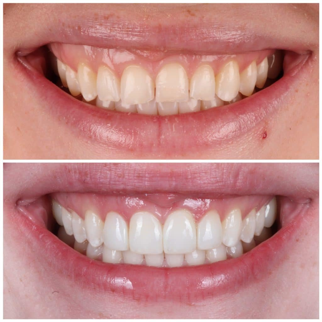 highlight Composite veneers