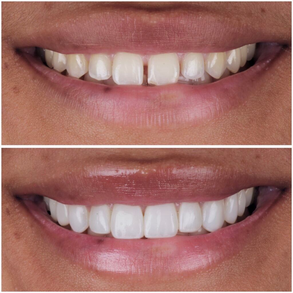 Highlight Composite Veneers