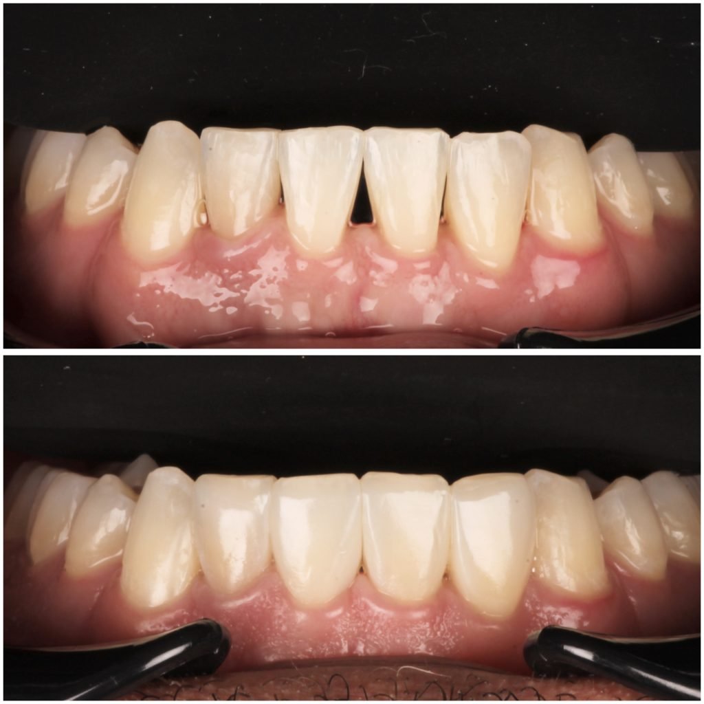 Bioclear Black Triangle Closure
