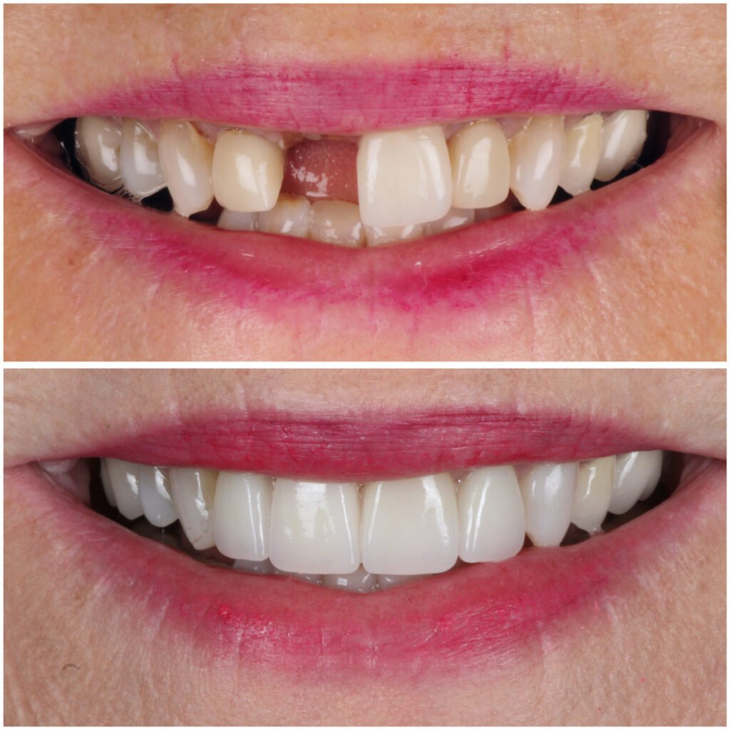 Smile Makeover to replace one missing tooth with a dental implant