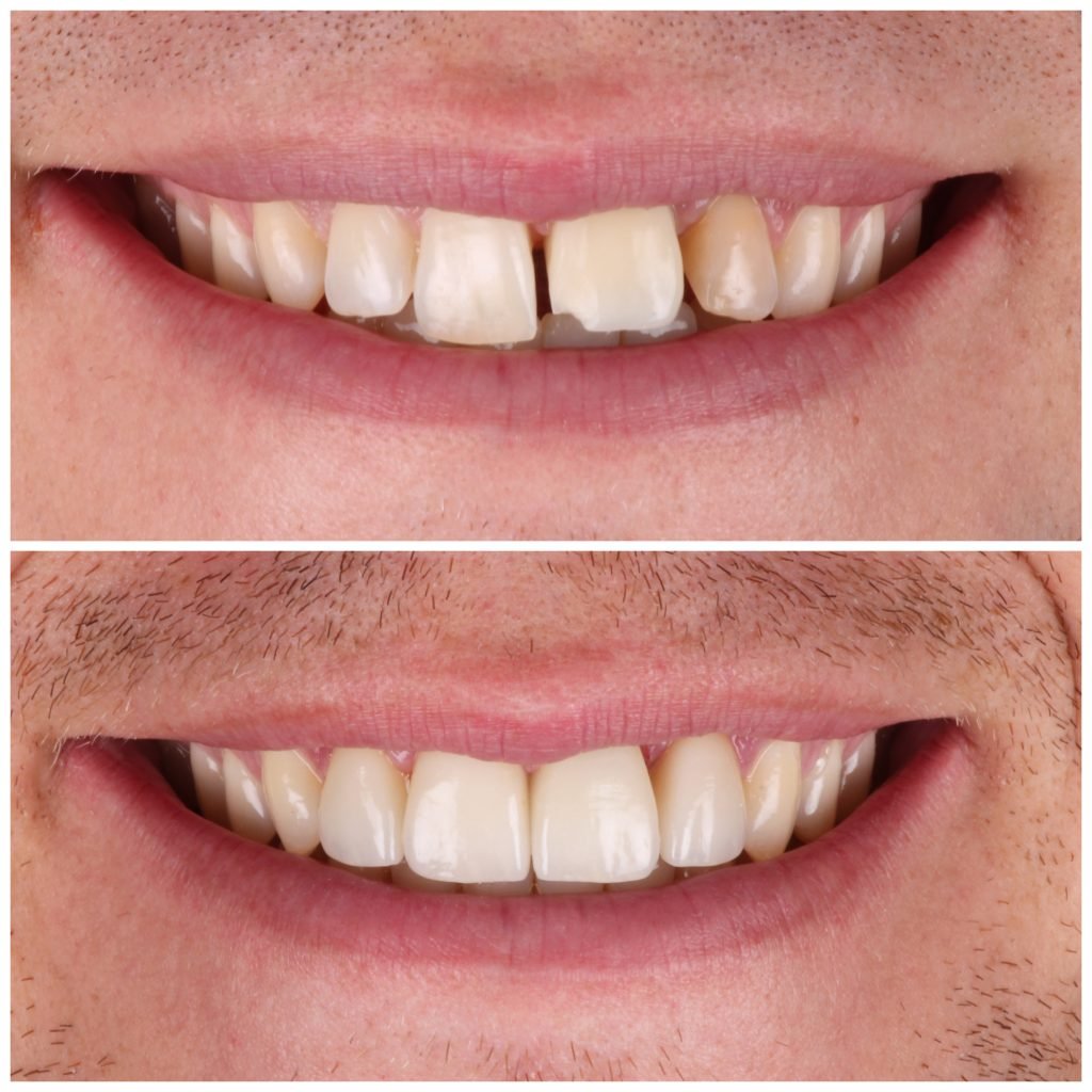 Implant and 3 veneers