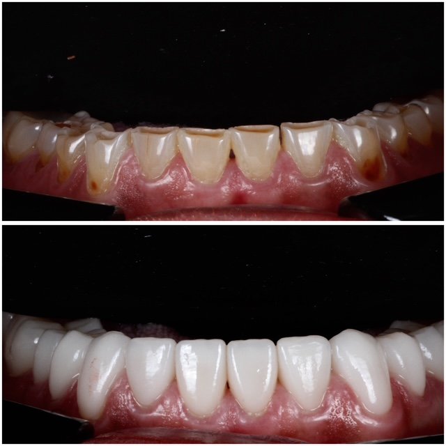 Lower teeth veneers