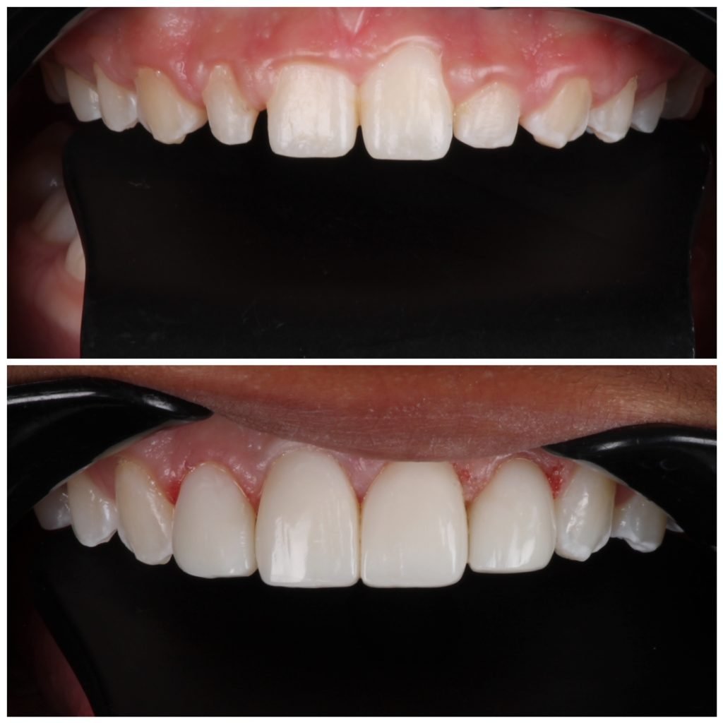 4 composite veneers and gum lift to correct peg laterals