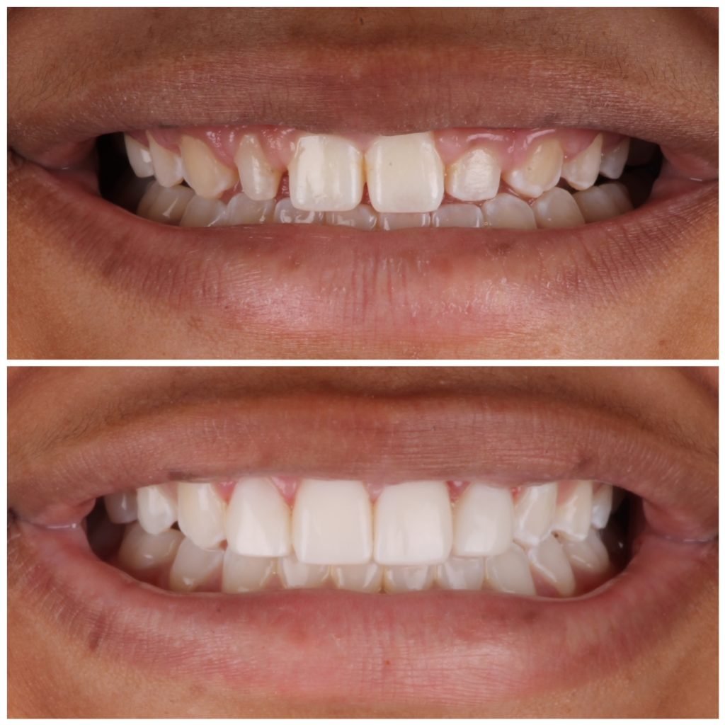 4 composite veneers to correct peg laterals