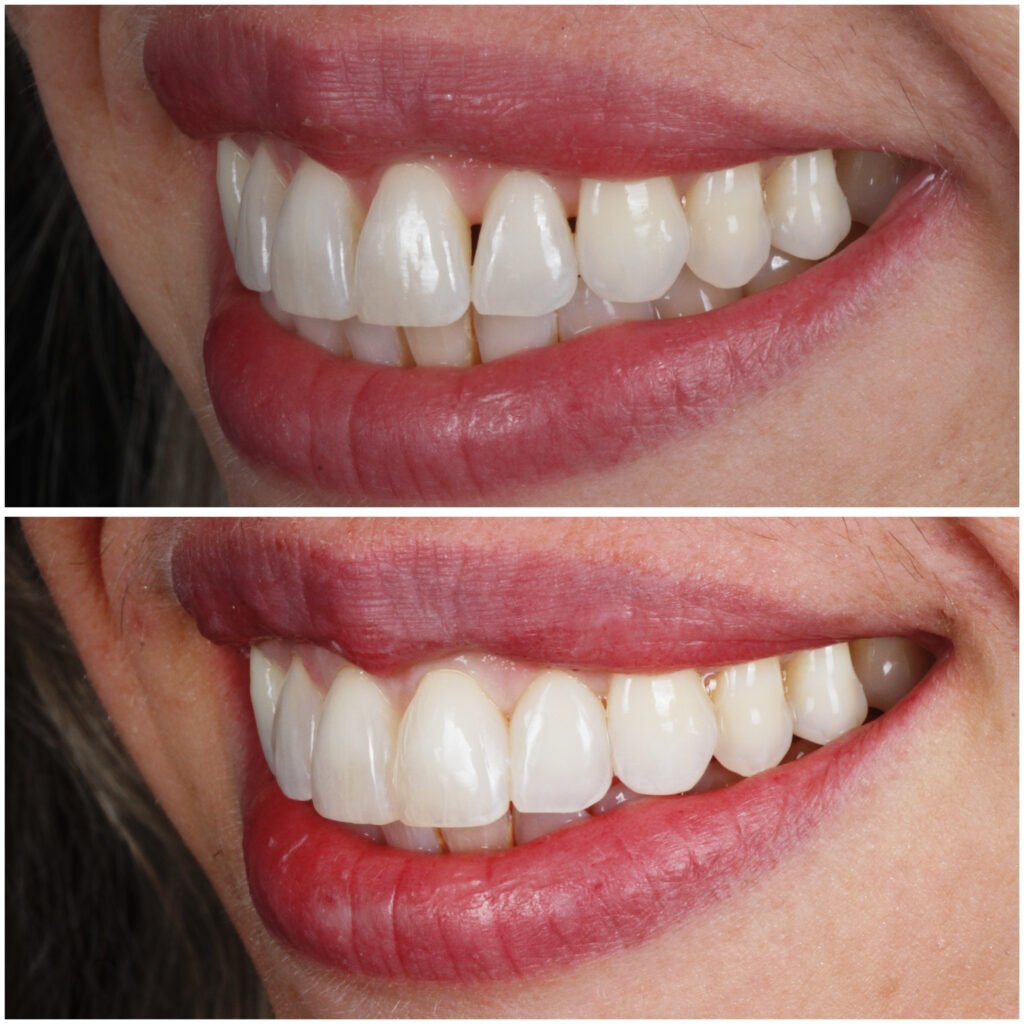 Bioclear Black Triangle Closure