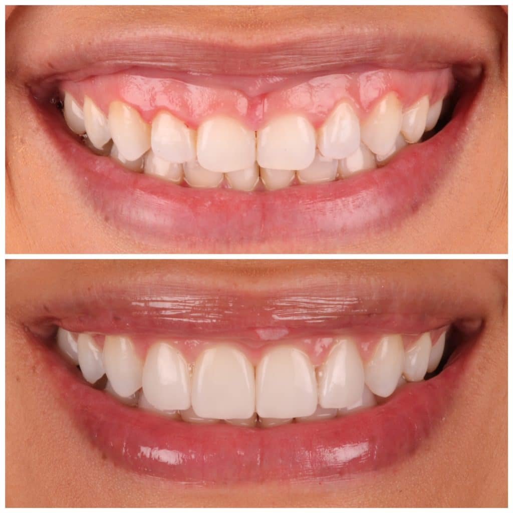 No Prep Veneers Austin Artistic Dental 1 Cosmetic Dentist in Austin