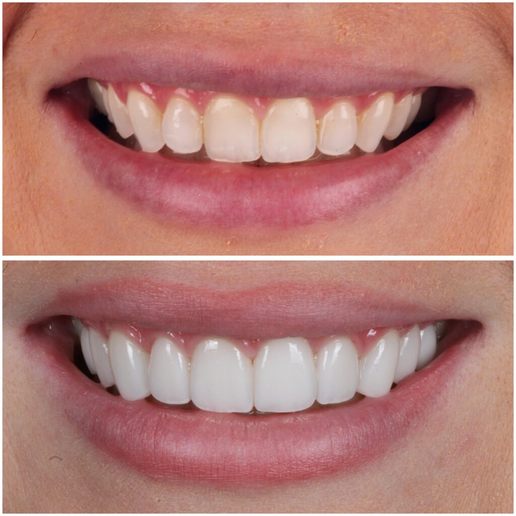 Perfect Smile Makeover