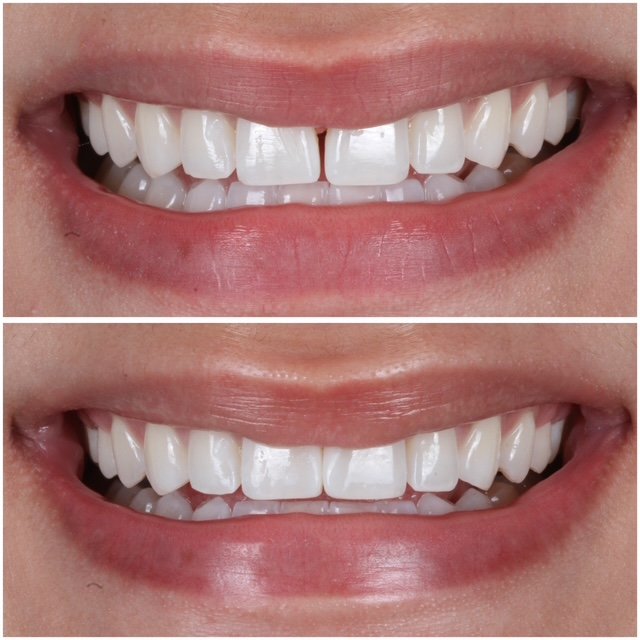 Bioclear Space Closures