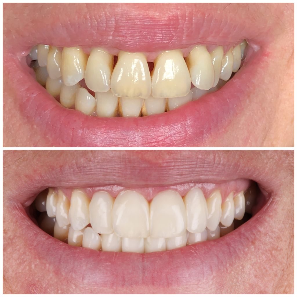 Upper and lower Black Triangles fixed with Bioclear