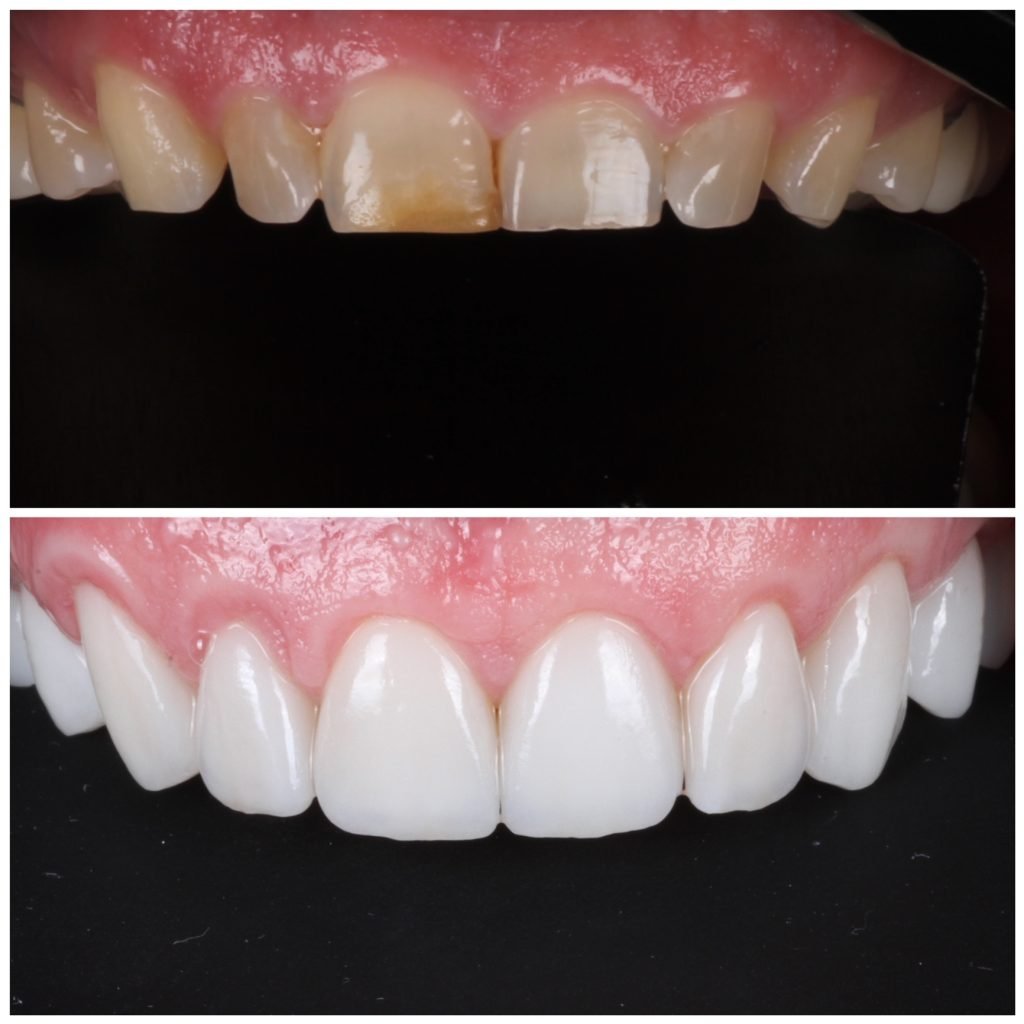 Gum lift and Smile Makeover with porcelain veneers
