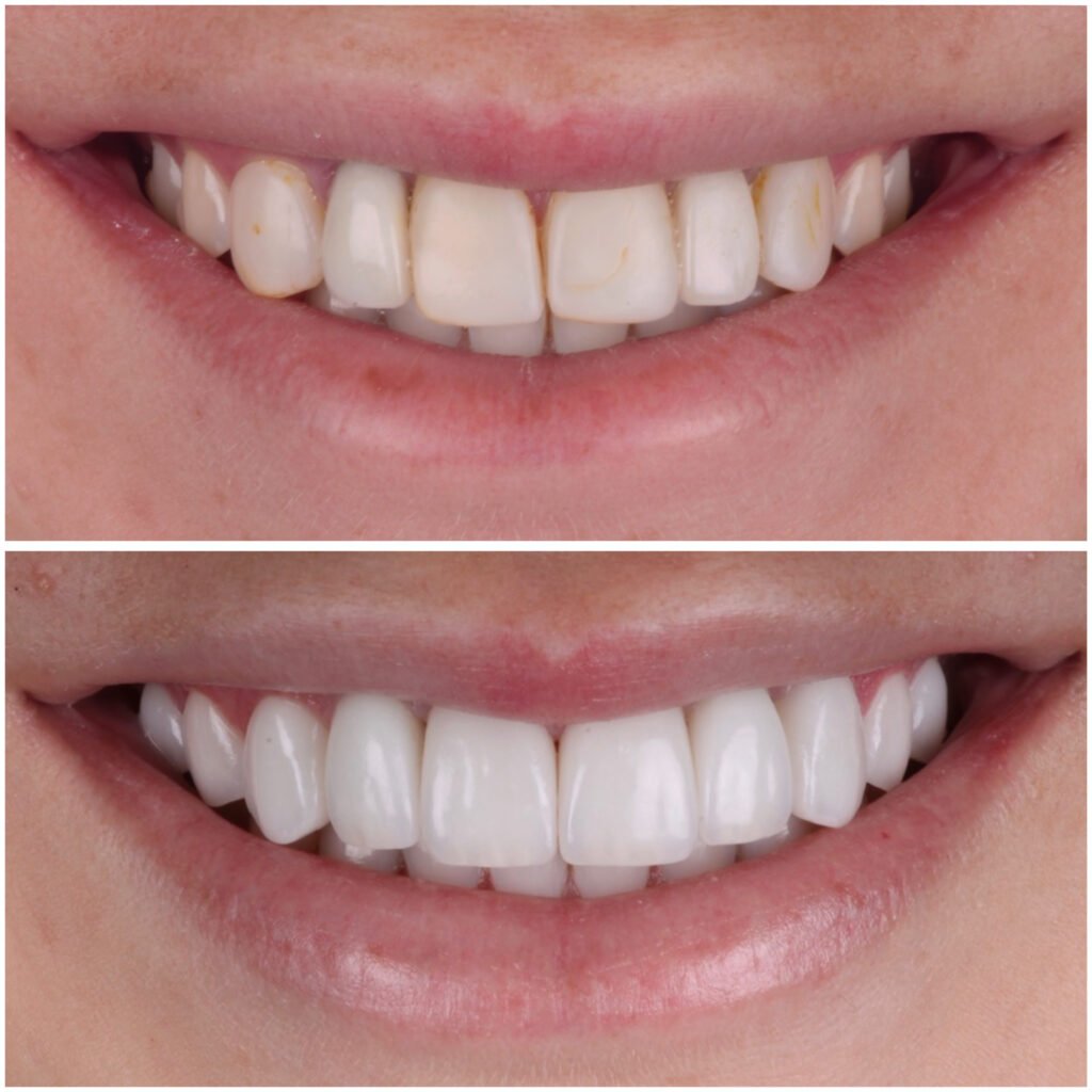 Porcelain Veneers and Implants Smile Makeover