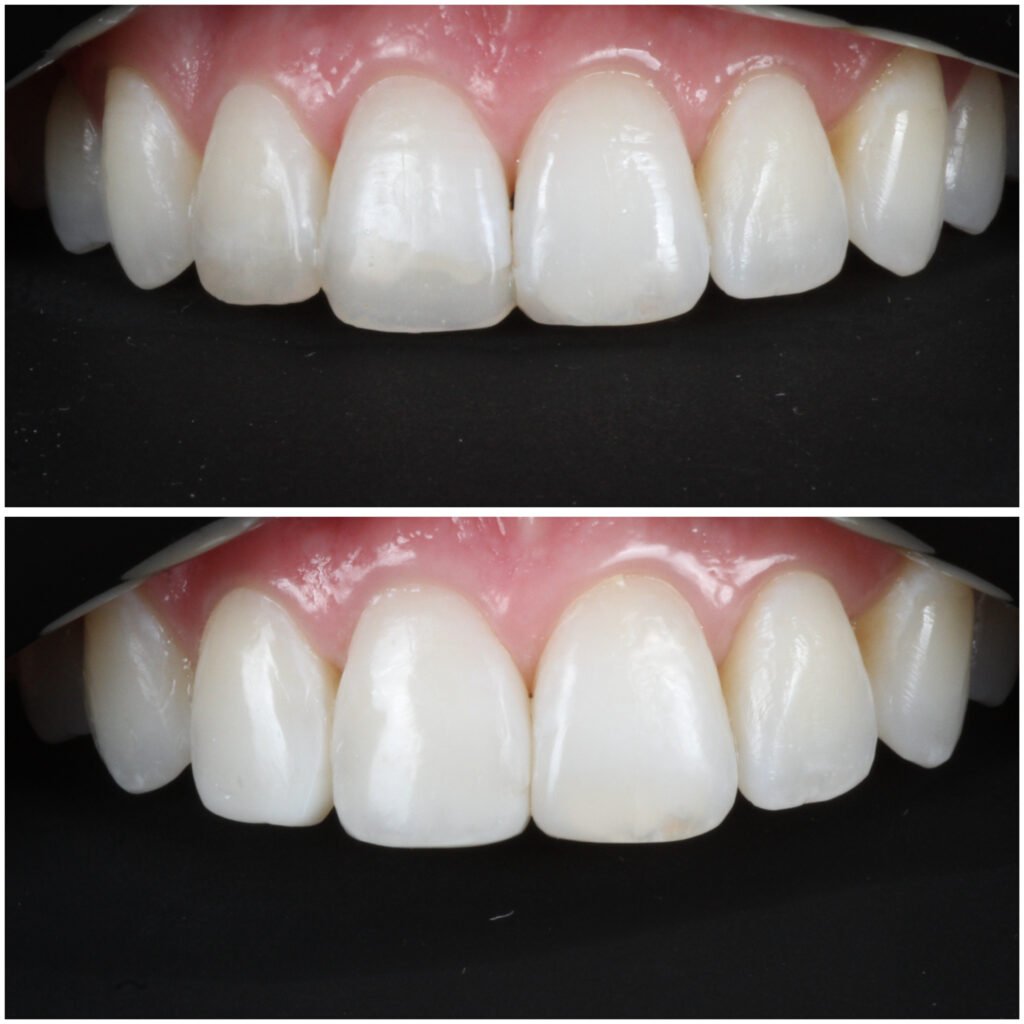 Bonding replaced with Highlight Veneers