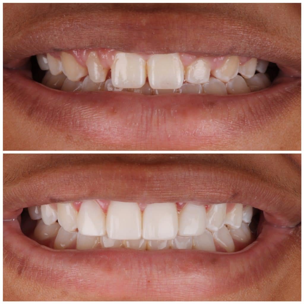 Teenager Smile Makeover with Bioclear Veneers