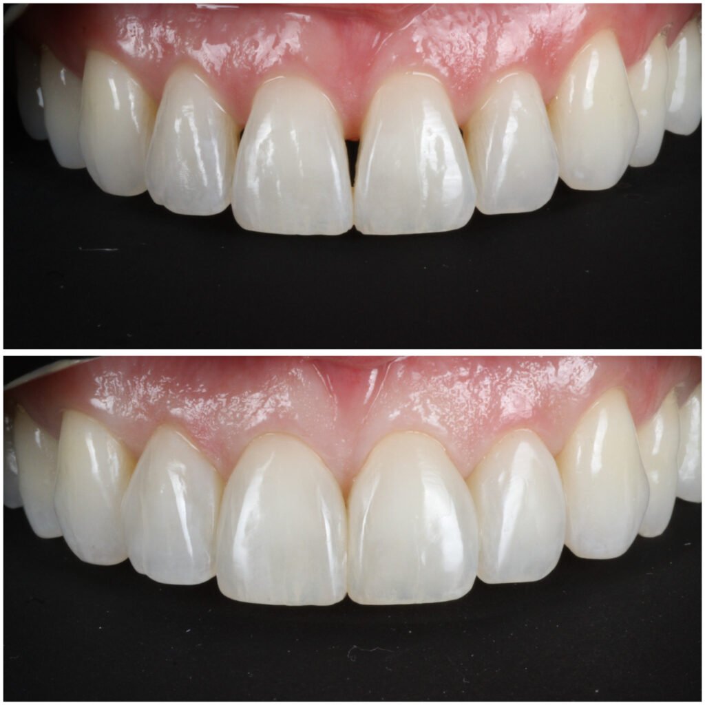 Bioclear Black Triangle Closure