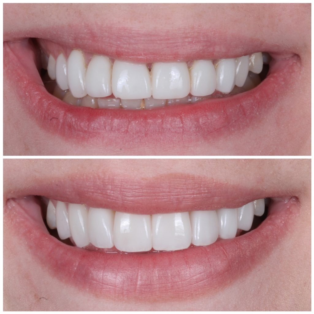Replacement Porcelain Veneers