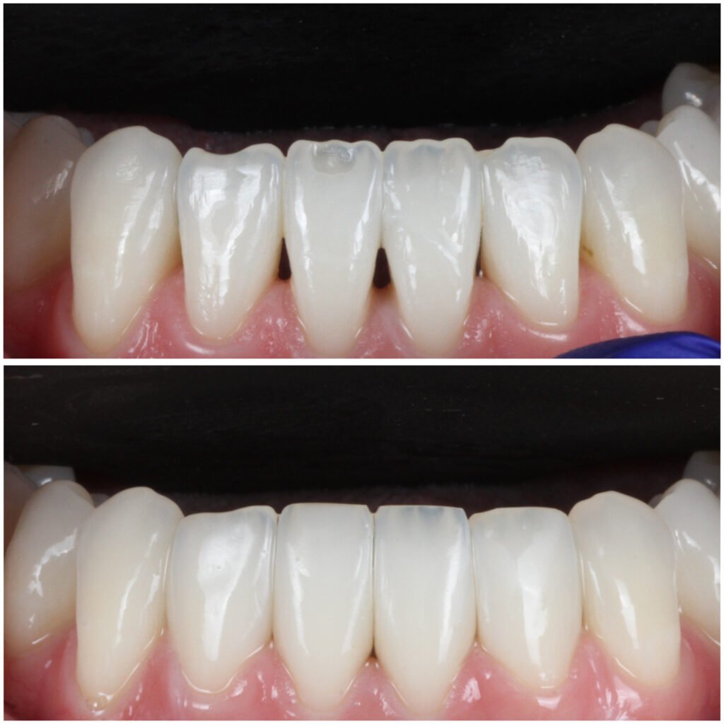 Bioclear Black Triangle Closure