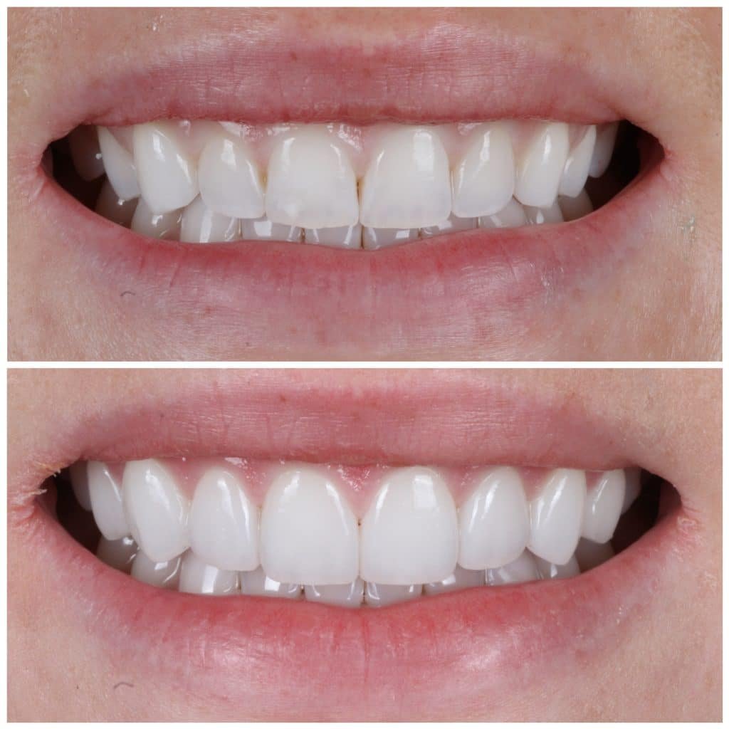 No Prep Porcelain Veneers