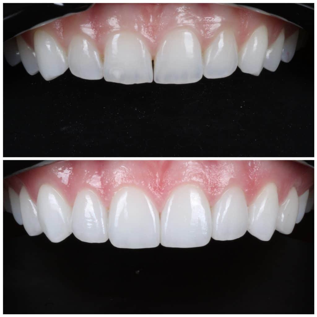 No Prep No Cut Porcelain Veneers
