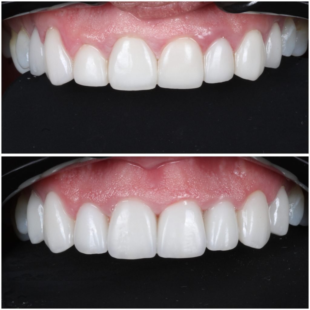 Replacement porcelain veneers