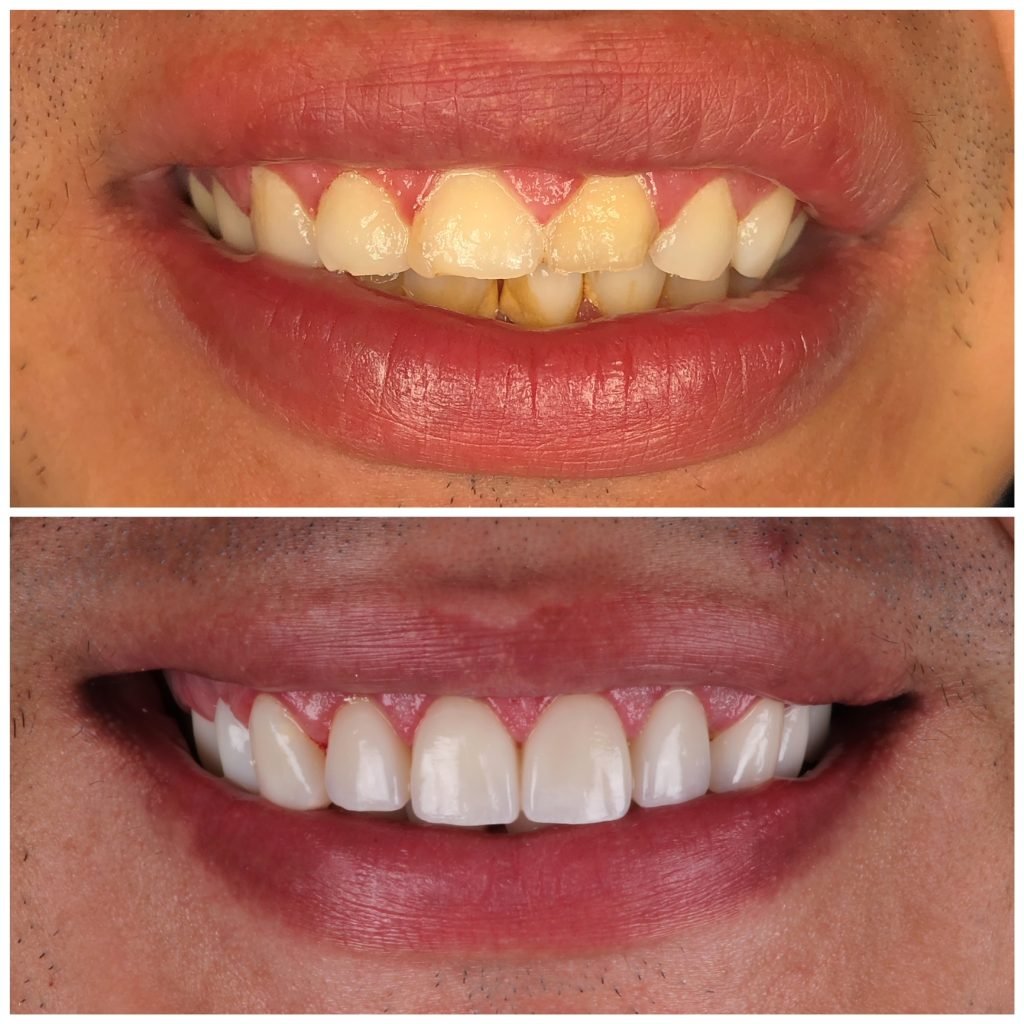 Smile makeover