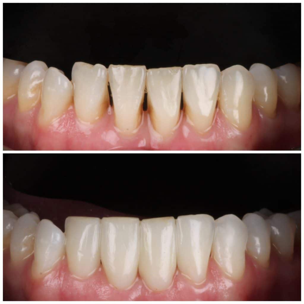 Black Triangles on lower teeth