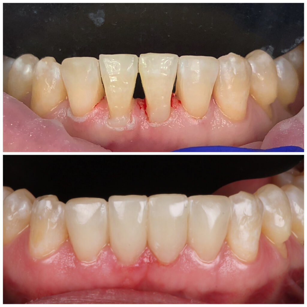 Bioclear Black Triangles