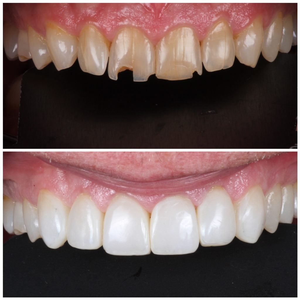Highlight Composite Veneers