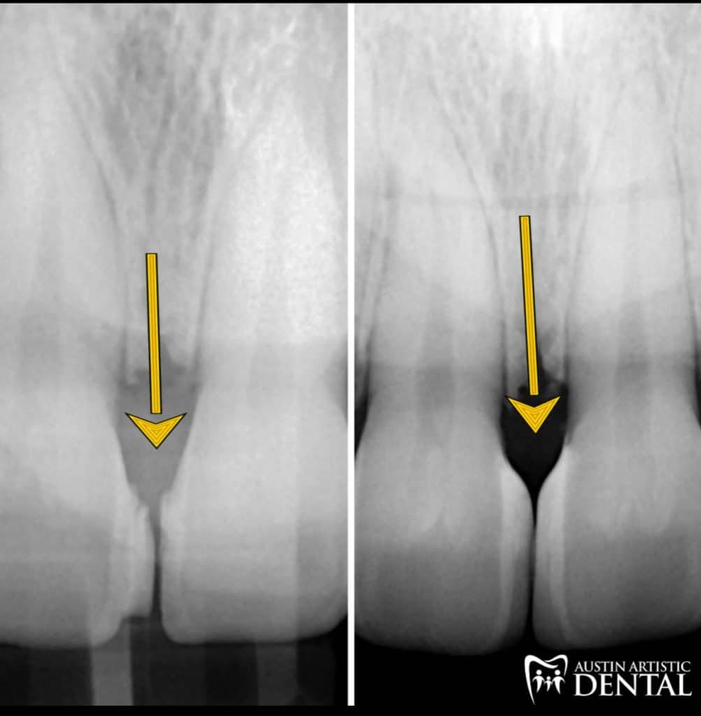 X-ray of Bioclear Black Triangle Closure