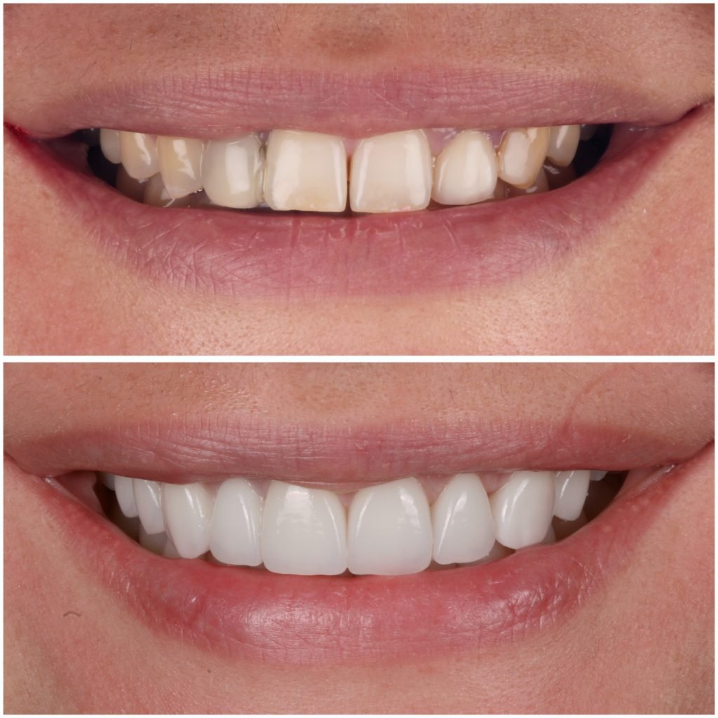 Porcelain Veneers and Bridges Smile makeover