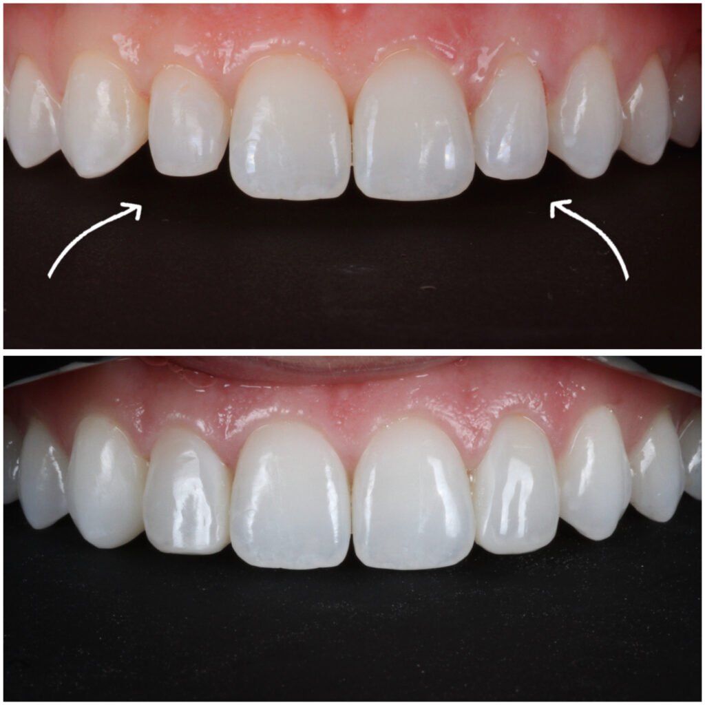 Peg Laterals restored with Highlight Composite Veneers