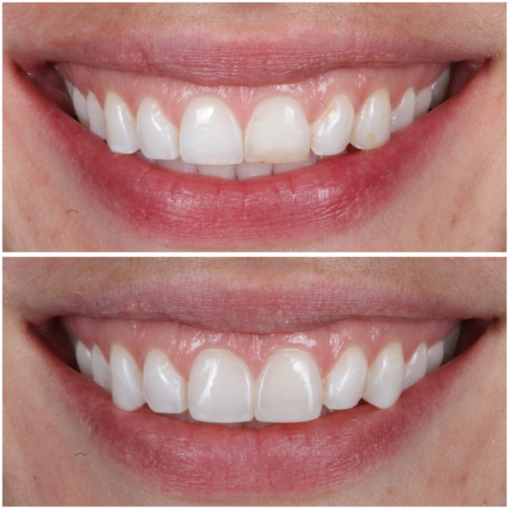 Bonding replaced with Highlight Composite Veneers