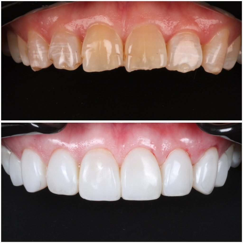 Highlight composite Veneers Smile Makeover
