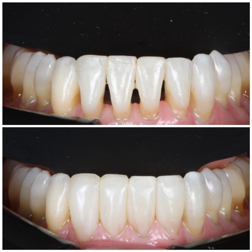 Bioclear Black Triangle Closure