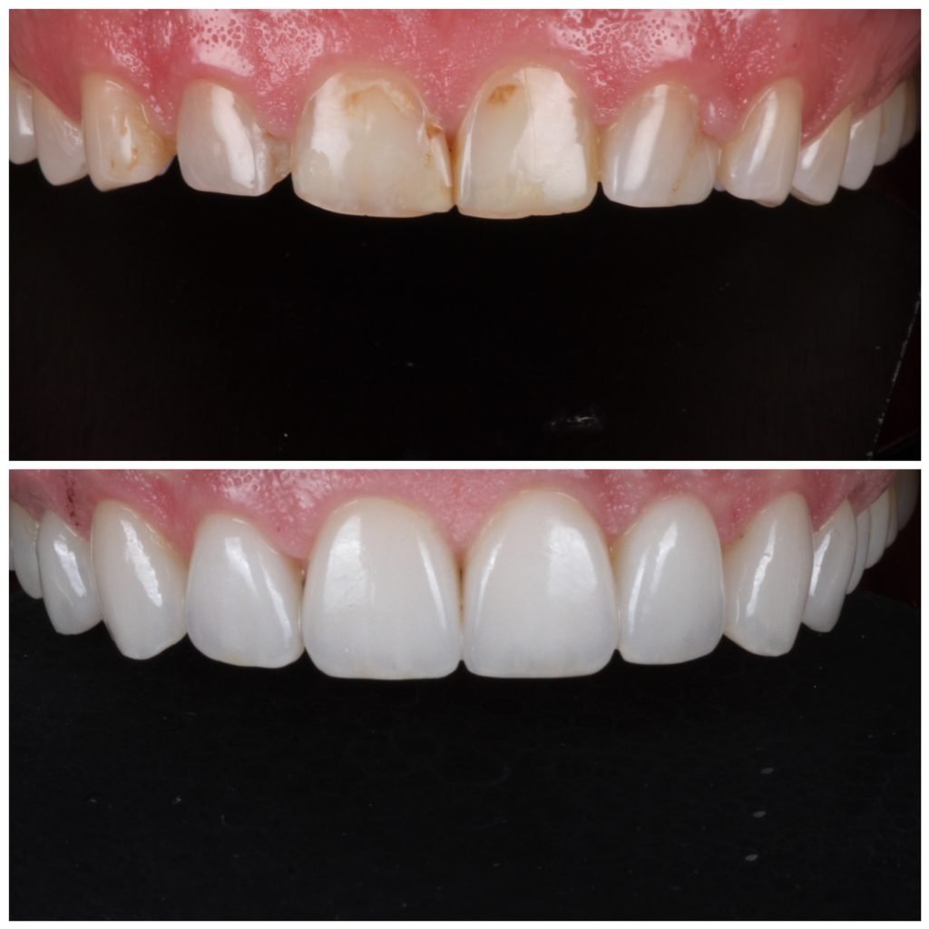 Natural Looking Porcelain Veneers Smile Makeover Gallery