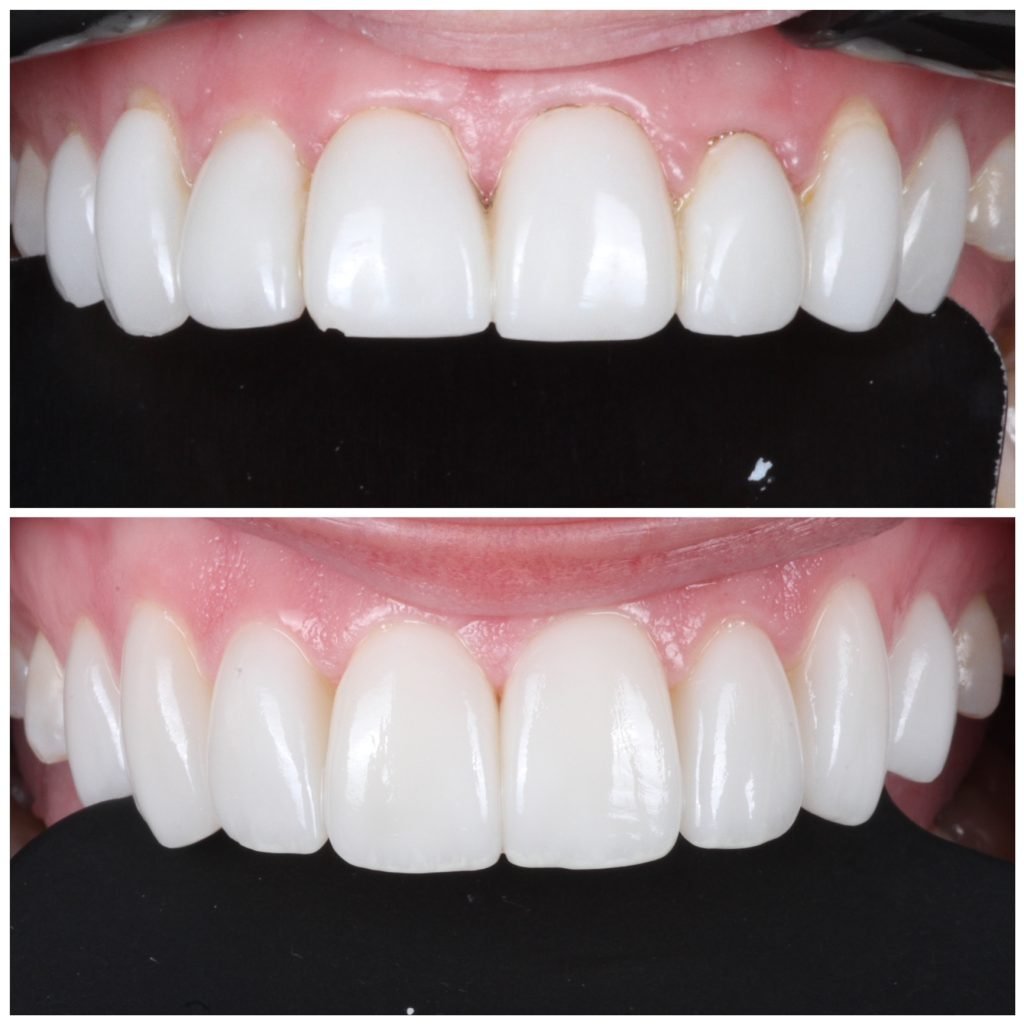 Replacement Porcelain Veneers