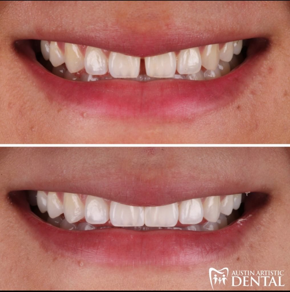 Teeth Space closure with Bioclear