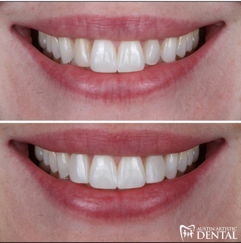Peg Laterals restored with Highlight Composite Veneers