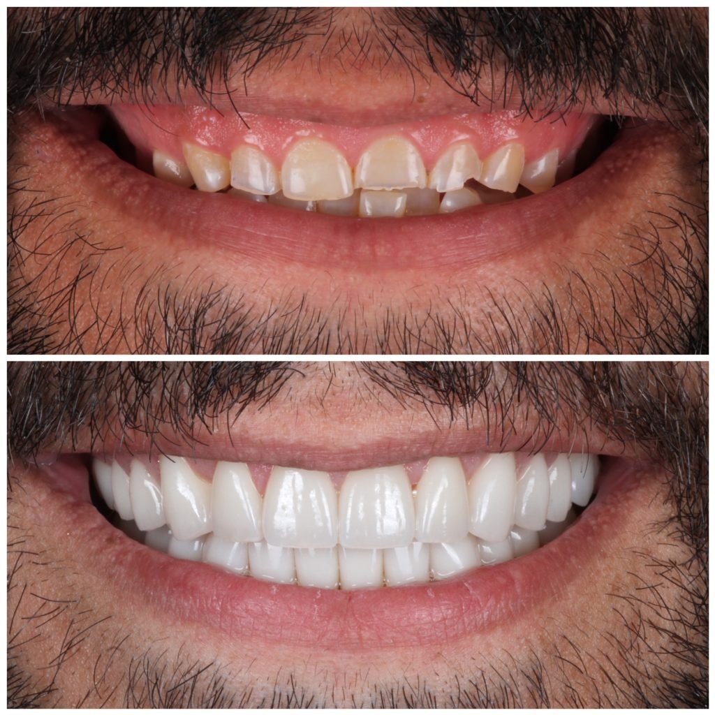 Full Mouth Reconstruction with porcelain veneers and crowns