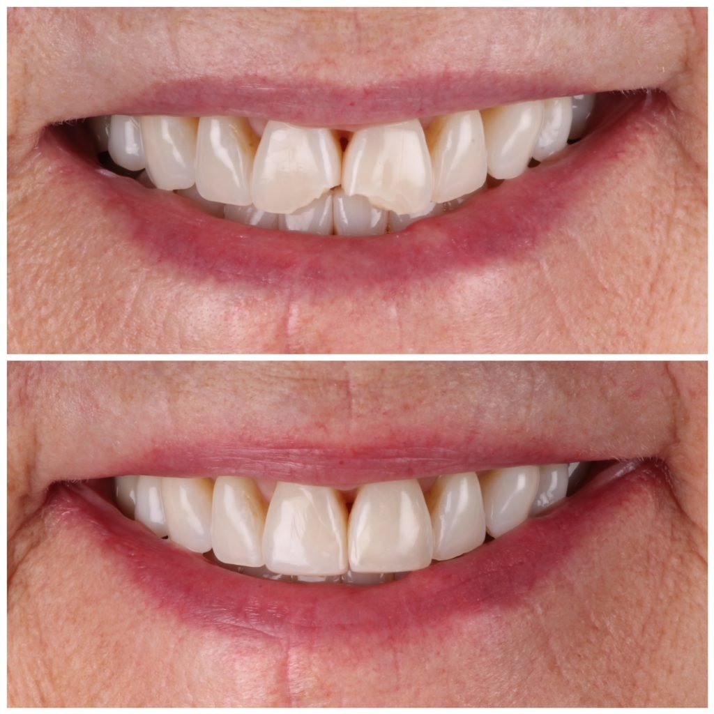 Broken teeth fixed with composite veneers