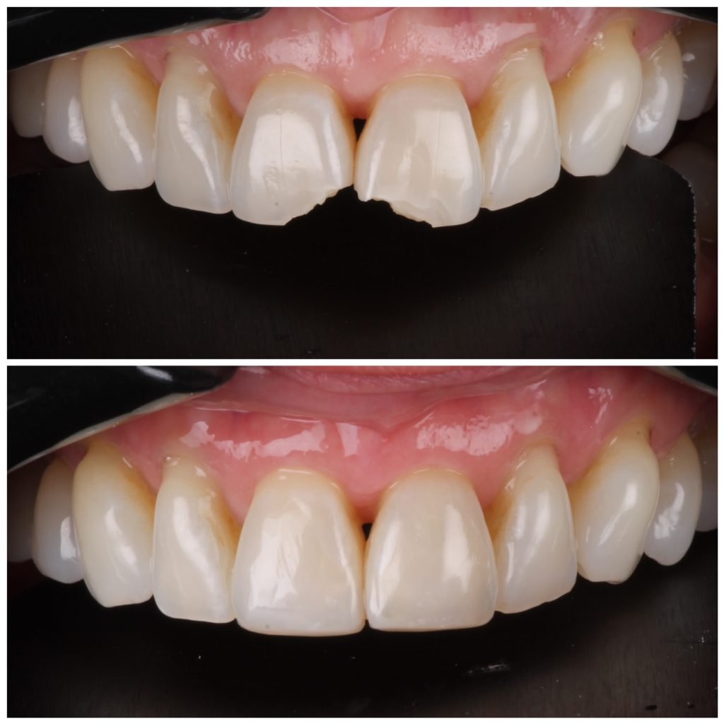 Broken teeth fixed with composite veneers