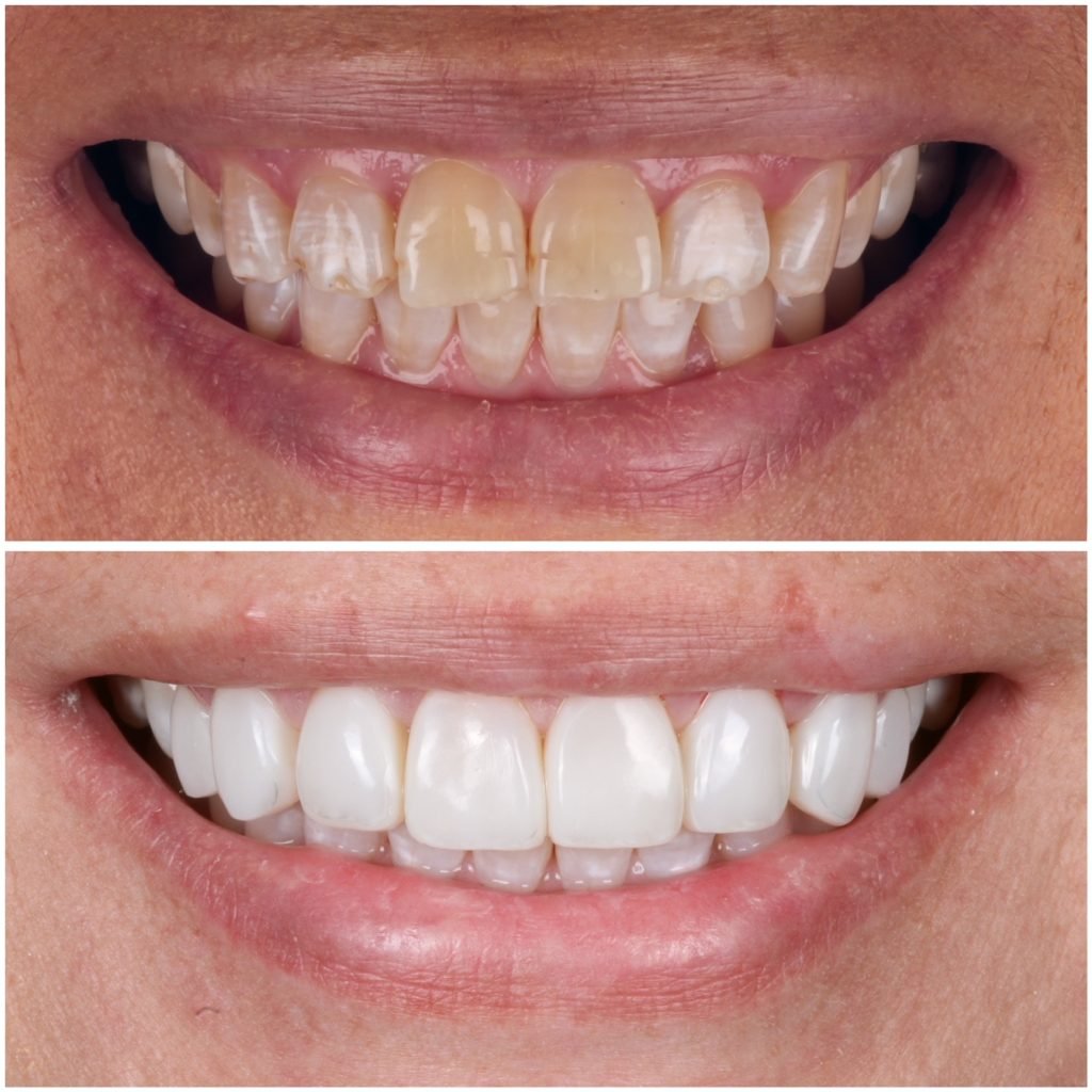 highlight Veneer
