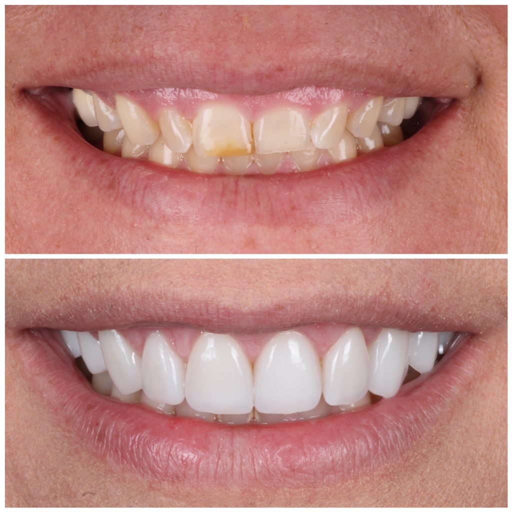Gum lift and Smile Makeover with porcelain veneers