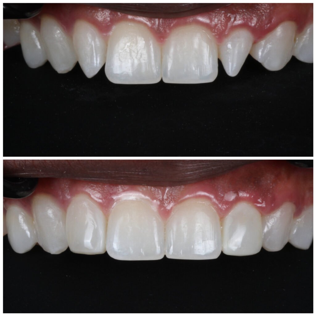 Composite Veneers for Peg Lateral Incisors